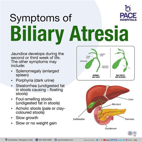 symptoms of bile leak|Bile Leak